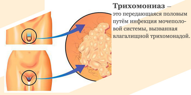 Трихомониаз это